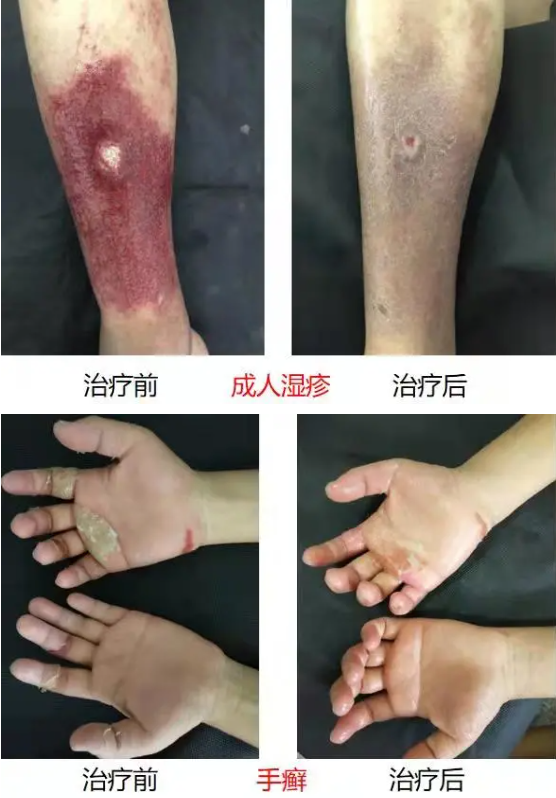 民间治疗蛇盘疮咒语_蛇盘疮怎么治疗_蛇盘疮最佳治疗方法截根方法